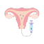 Ovulation induction and intrauterine insemination (IUI) 